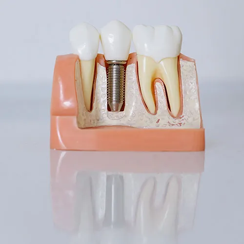 Dental implant model showing tooth replacement